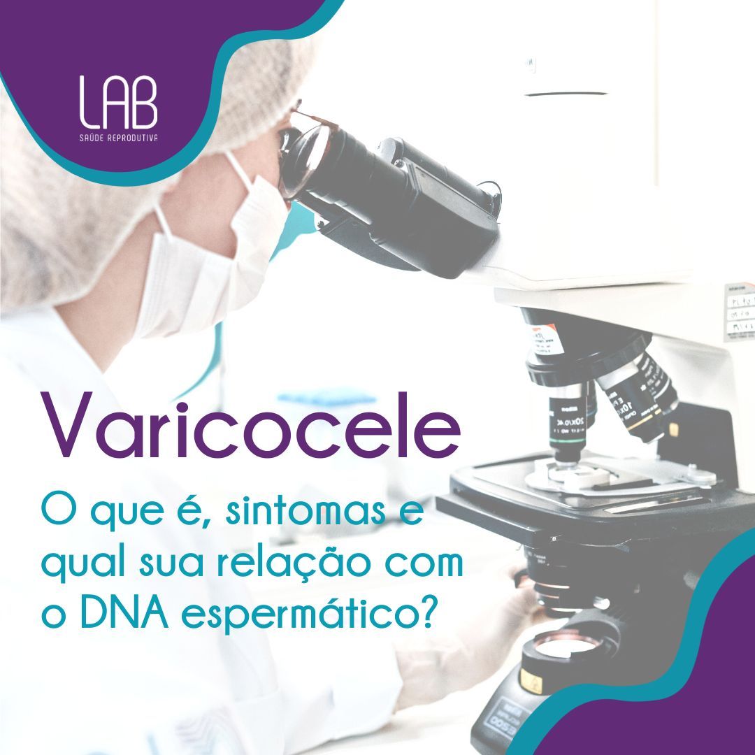 varicocele